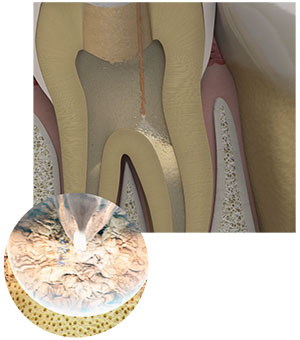 West San Angelo EdgePro Procedure